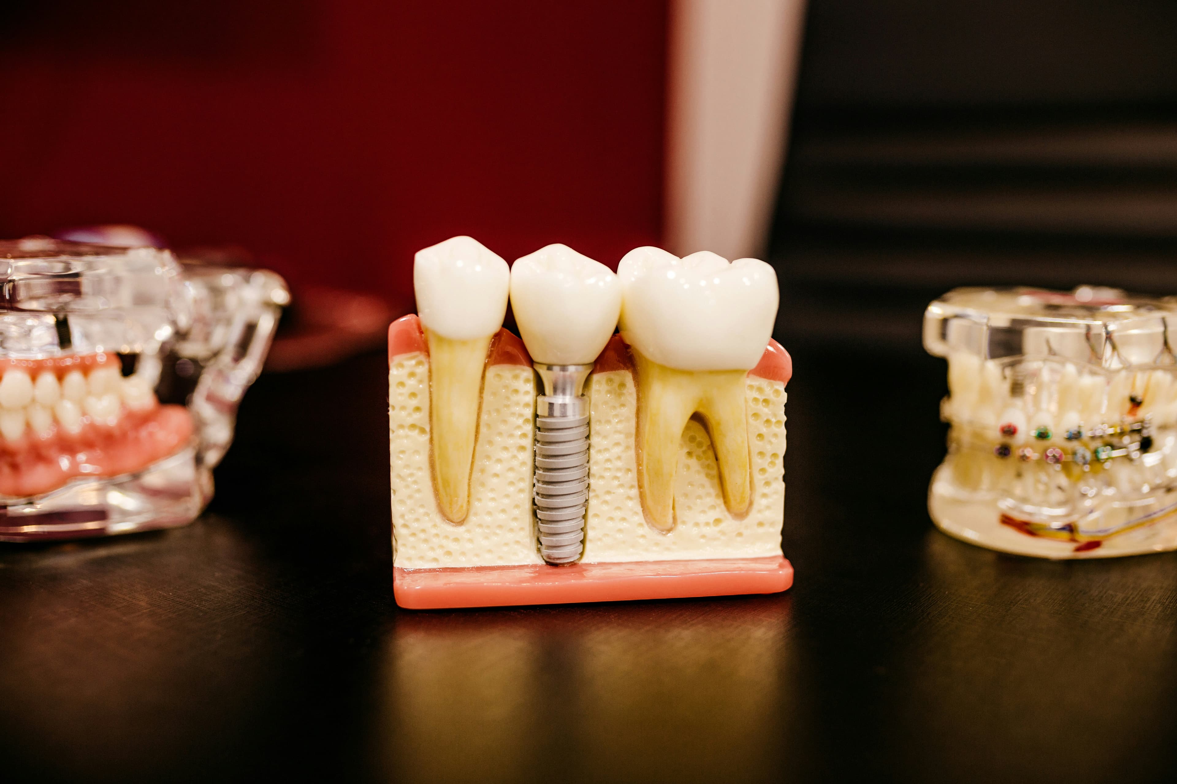 Dental Implants in Agoura Hills: Your Complete Guide to Permanent Tooth Replacement