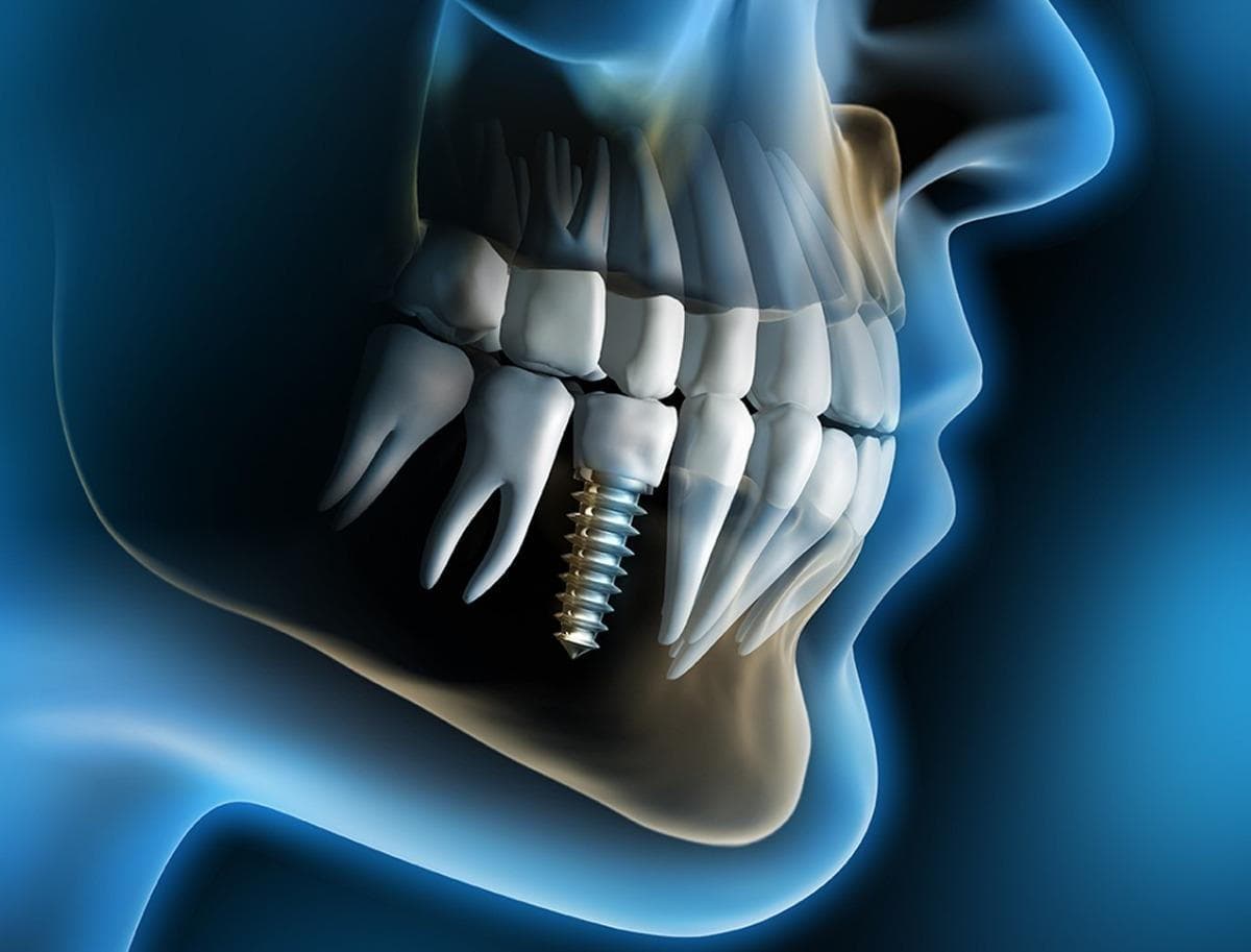 Dental Implants Placed by Our Skilled Periodontist